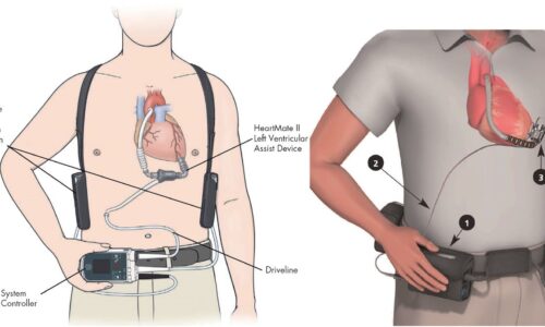 Ventricular Assist Devices Market