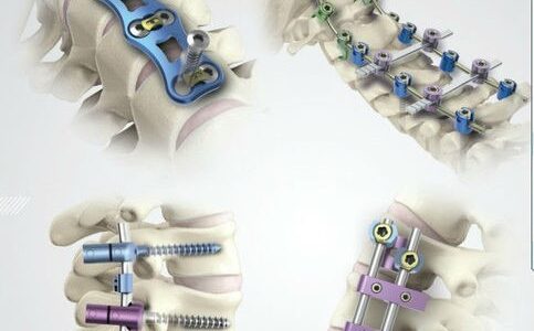 Spinal-Implant-and-Devices-Market