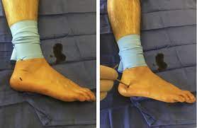 Foot and Ankle Allograft Market