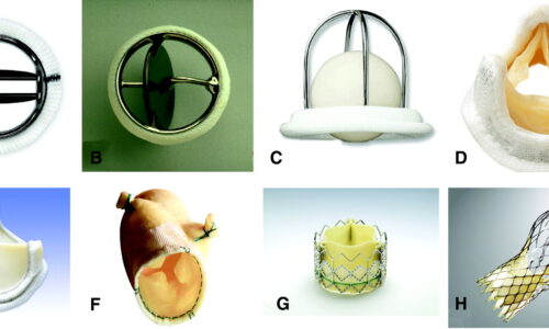 prosthetic heart valves market